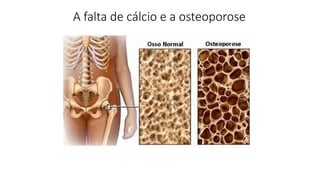 A falta de cálcio e a osteoporose
 