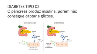 DIABETES TIPO 02
O pâncreas produz insulina, porém não
consegue captar a glicose.
 