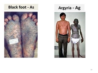 14
Black foot - As Argyria - Ag
 