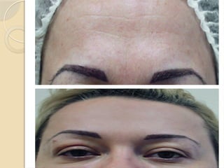 Skin aging process and his prevention by Biorevitalization | PPTX