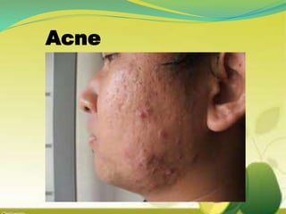 Acne
 