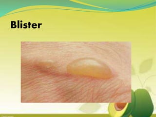 Blister
 