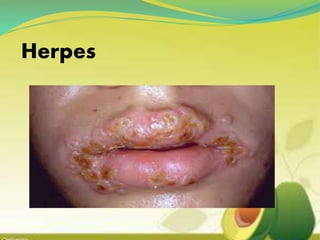 Herpes
 