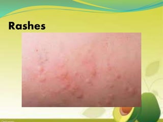 Rashes
 