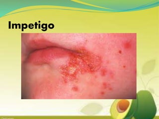 Impetigo
 