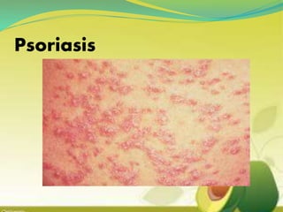 Psoriasis
 