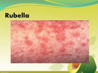 Rubella
 