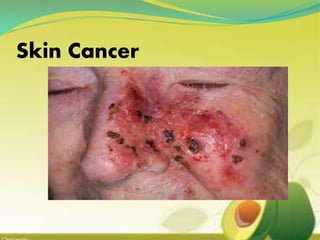 Skin Cancer
 