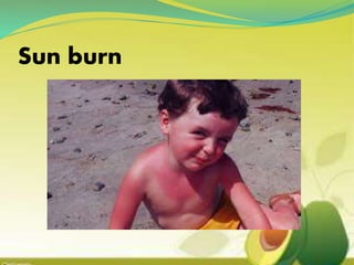 Sun burn
 