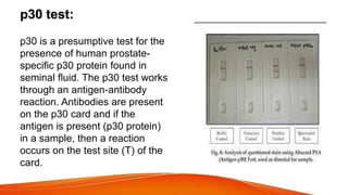 p30 test:
p30 is a presumptive test for the
presence of human prostate-
specific p30 protein found in
seminal fluid. The p...