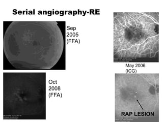 Serial angiography-RE
Sep
2005
(FFA)
May 2006
(ICG)
Oct
2008
(FFA)
RAP LESION
 