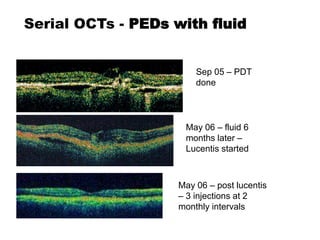 Serial OCTs - PEDs with fluid
Sep 05 – PDT
done
May 06 – post lucentis
– 3 injections at 2
monthly intervals
May 06 – fluid 6
months later –
Lucentis started
 