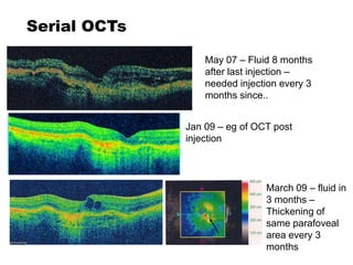 Serial OCTs
May 07 – Fluid 8 months
after last injection –
needed injection every 3
months since..
Jan 09 – eg of OCT post
injection
March 09 – fluid in
3 months –
Thickening of
same parafoveal
area every 3
months
 
