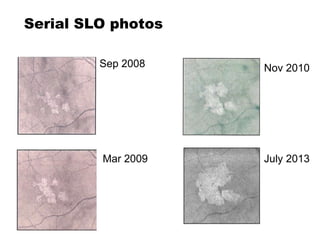 Serial SLO photos
Nov 2010
Mar 2009
Sep 2008
July 2013
 