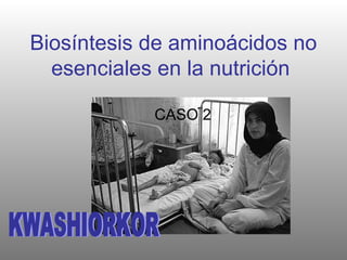 Biosíntesis de aminoácidos no esenciales en la nutrición   CASO 2 KWASHIORKOR 