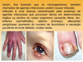 Assim, fica ilustrado que os microrganismos, também
chamados de agentes infecciosos, podem causar infecção.
Infecção é uma doença caracterizada pela presença de
agentes infecciosos que provocam danos em determinados
órgãos ou tecidos do nosso organismo causando febre, dor,
eritema
(vermelhidão),
edema
(inchaço),
alterações
sangüíneas (aumento do numero de leucócitos) e secreção
purulenta do local afetado, muitas vezes.

 