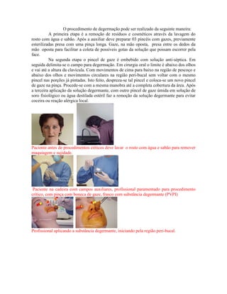 O procedimento de degermação pode ser realizado da seguinte maneira:
A primeira etapa é a remoção de resíduos e cosméticos através da lavagem do
rosto com água e sabão. Após a auxiliar deve preparar 03 pincéis com gazes, previamente
esterilizadas presa com uma pinça longa. Gaze, na mão oposta, presa entre os dedos da
mão oposta para facilitar a coleta de possíveis gotas da solução que possam escorrer pela
face.
Na segunda etapa o pincel de gaze é embebido com solução anti-séptica. Em
seguida delimita-se o campo para degermação. Em cirurgia oral o limite é abaixo dos olhos
e vai até a altura da clavícula. Com movimentos de cima para baixo na região de pescoço e
abaixo dos olhos e movimentos circulares na região peri-bucal sem voltar com o mesmo
pincel nas porções já pintadas. Isto feito, despreza-se tal pincel e coloca-se um novo pincel
de gaze na pinça. Procede-se com a mesma manobra até a completa cobertura da área. Após
a terceira aplicação da solução degermante, com outro pincel de gaze úmida em solução de
soro fisiológico ou água destilada estéril faz a remoção da solução degermante para evitar
coceira ou reação alérgica local.
Paciente antes de procedimentos críticos deve lavar o rosto com água e sabão para remover
maquiagem e sujidade.
Paciente na cadeira com campos auxiliares, profissional paramentado para procedimento
crítico, com pinça com boneca de gaze, frasco com substância degermante (PVPI)
Profissional aplicando a substância degermante, iniciando pela região peri-bucal.
 