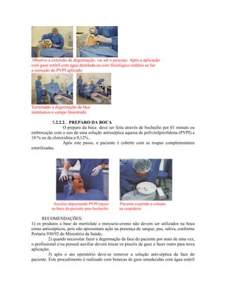 Observe a extensão da degermação, vai até o pescoço. Após a aplicação
com gaze estéril com água destilada ou soro fisiológico estéreis se faz
a remoção do PVPI aplicado.
Terminado a degermação da face
instalamos o campo fenestrado.
5.2.2.2. . PREPARO DA BOCA
O preparo da boca deve ser feita através de bochecho por 01 minuto ou
embrocação com o uso de uma solução antisséptica aquosa de polivinilpirolidona (PVPI) a
10 % ou de clorexidina a 0,12%..
Após este passo, o paciente é coberto com as roupas complementares
esterilizadas.
Auxiliar depositando PVPI tópico Paciente cuspindo a solução
na boca da paciente para bochecho na cuspideira
RECOMENDAÇÕES:
1) os produtos a base de mertiolate e mercurio-cromo não devem ser utilizados na boca
como antissépticos, pois não apresentam ação na presença de sangue, pus, saliva, conforme
Portaria 930/92 do Ministério da Saúde;
2) quando necessitar fazer a degermação da face do paciente por mais de uma vez,
o profissional e/ou pessoal auxiliar deverá trocar os pincéis de gaze e fazer outro para nova
aplicação;
3) após o ato operatório deve-se remover a solução anti-séptica da face do
paciente. Este procedimento é realizado com bonecas de gaze umedecidas com água estéril
 
