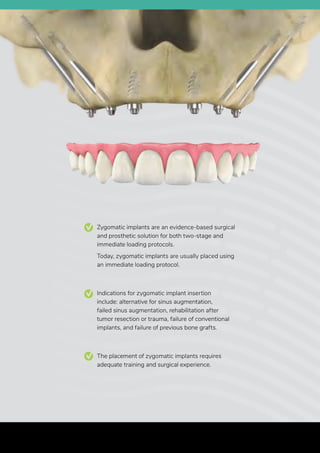 Zygomatic implants are an evidence-based surgical
and prosthetic solution for both two-stage and
immediate loading protocols.
Today, zygomatic implants are usually placed using
an immediate loading protocol.
Indications for zygomatic implant insertion
include: alternative for sinus augmentation,
failed sinus augmentation, rehabilitation after
tumor resection or trauma, failure of conventional
implants, and failure of previous bone grafts.
The placement of zygomatic implants requires
adequate training and surgical experience.
Biotec 2019 Product Catalog | 57
 