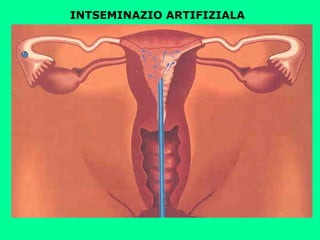 INTSEMINAZIO ARTIFIZIALA
 