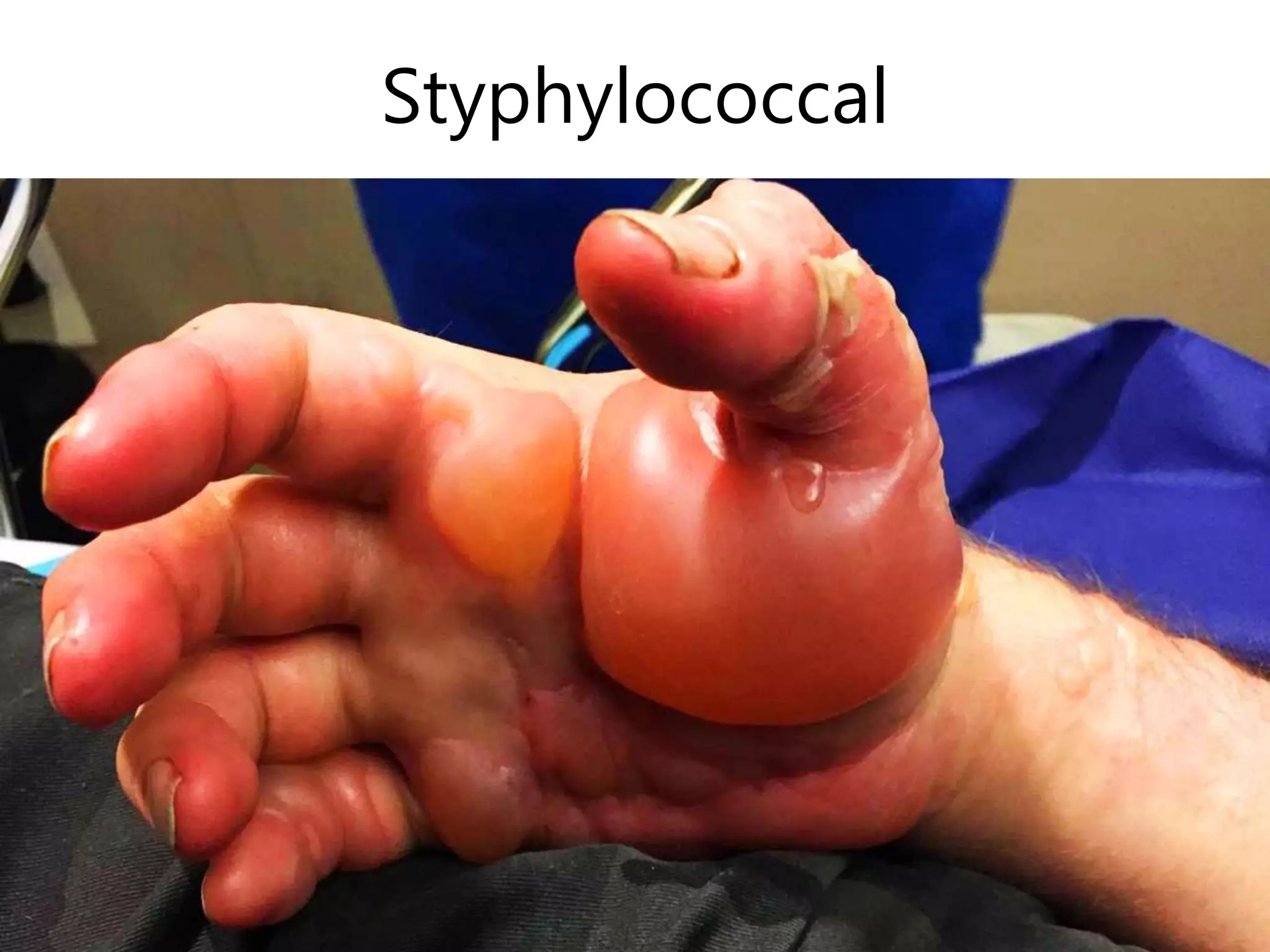 Styphylococcal
 