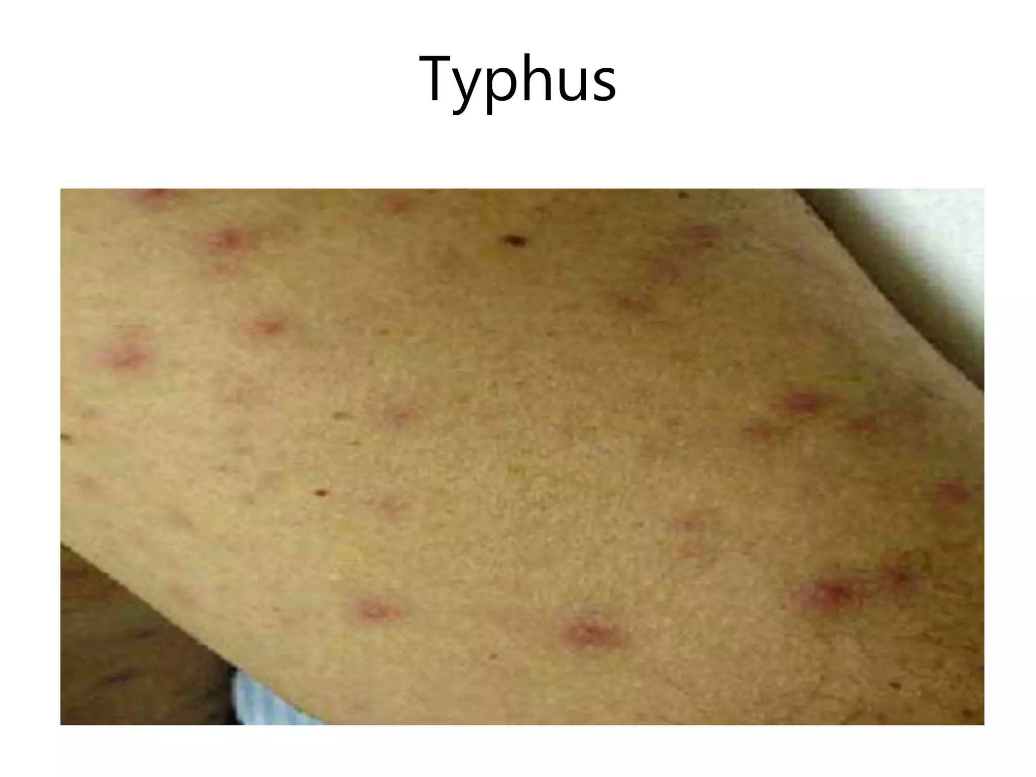 Typhus
 