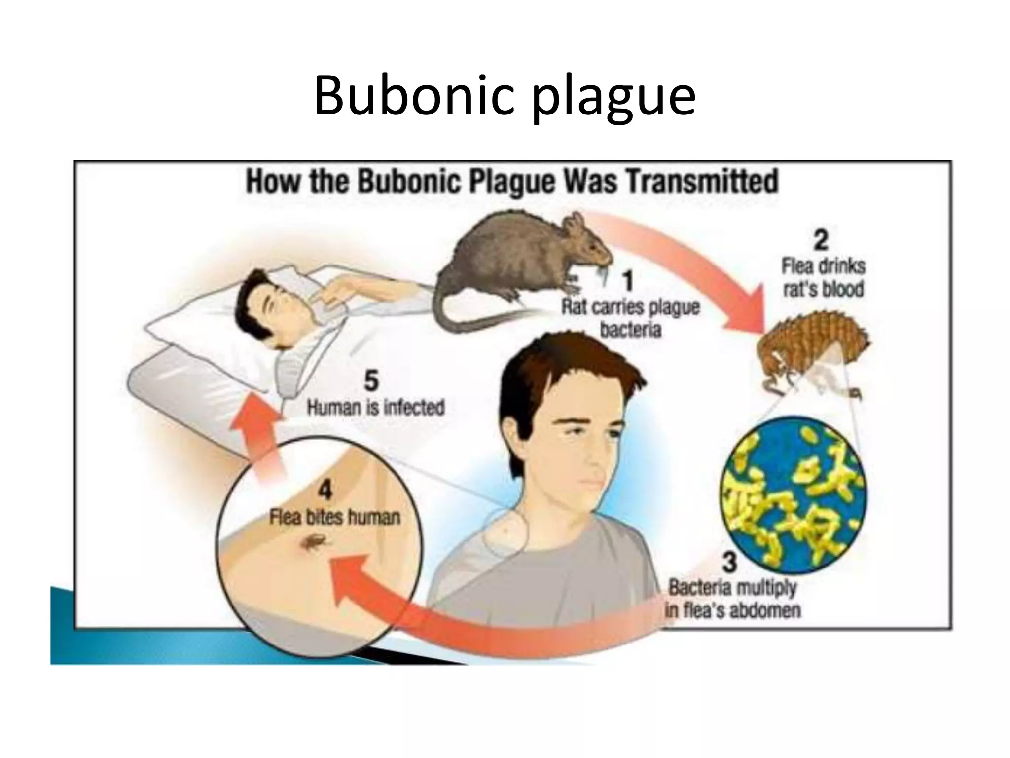 Bubonic plague
 
