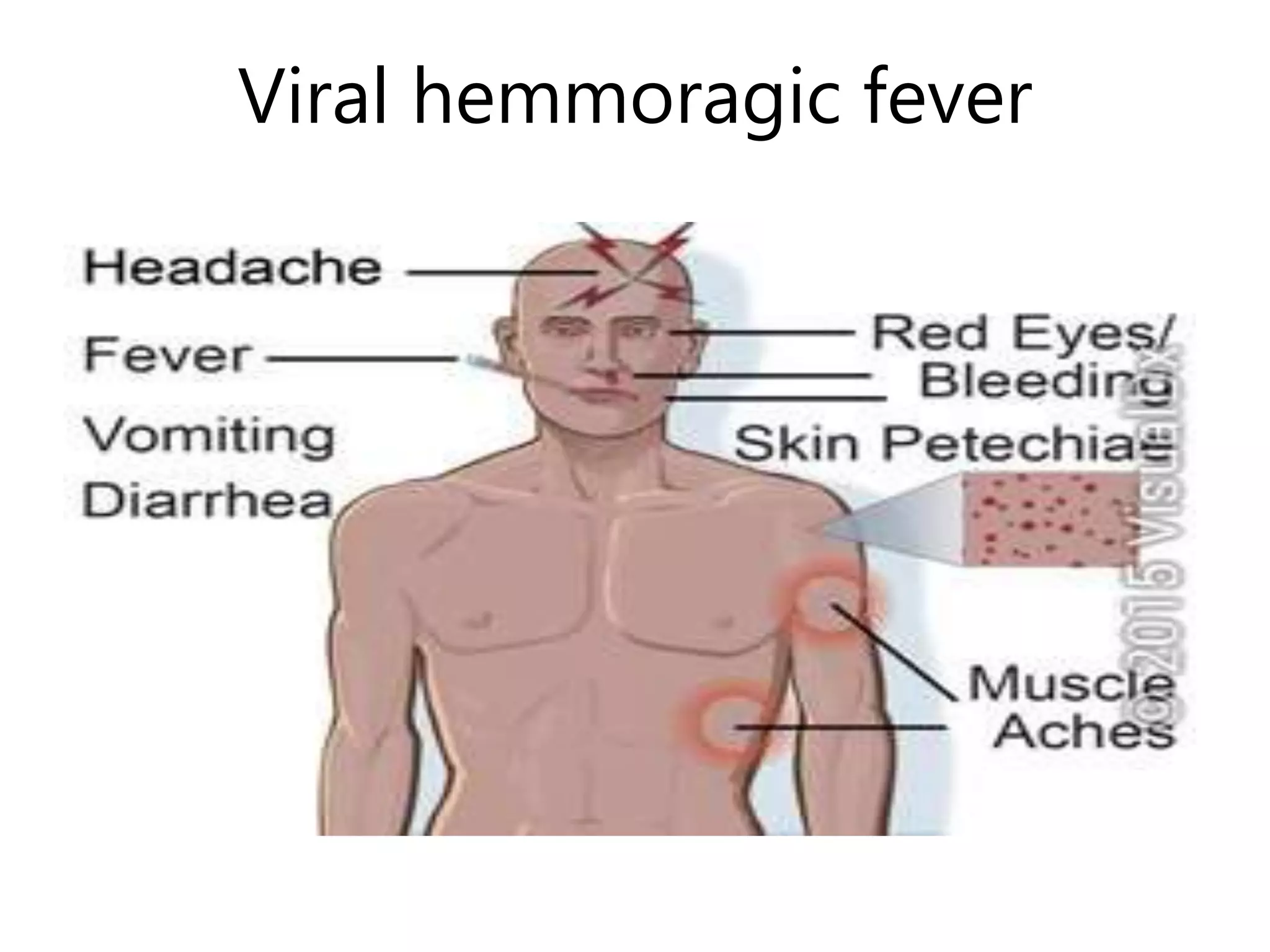 Viral hemmoragic fever
 