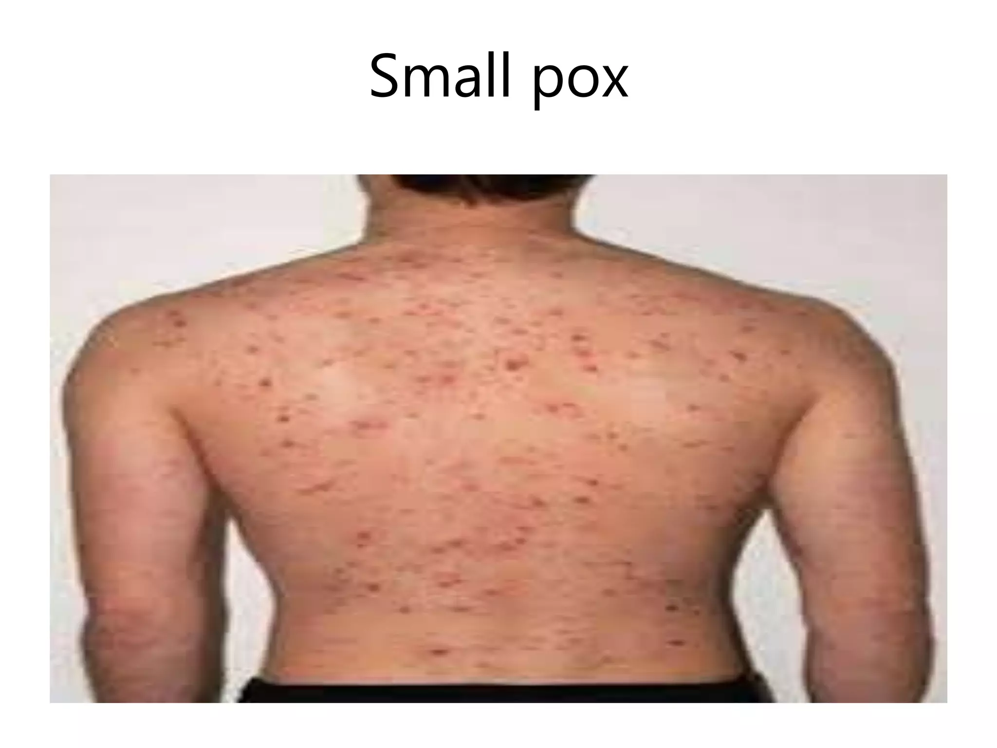 Small pox
 