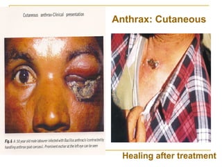Anthrax: Cutaneous
Healing after treatment
 