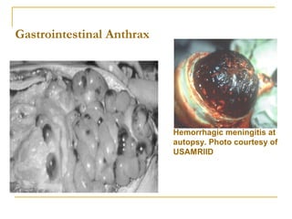 Gastrointestinal Anthrax
Hemorrhagic meningitis at
autopsy. Photo courtesy of
USAMRIID
 