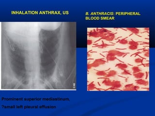 INHALATION ANTHRAX, US
Prominent superior mediastinum,
?small left pleural effusion
B. ANTHRACISB. ANTHRACIS: PERIPHERAL: PERIPHERAL
BLOOD SMEARBLOOD SMEAR
 