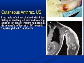 Cutaneous Anthrax, USCutaneous Anthrax, US
7 mo male infant hospitalized with 2 day7 mo male infant hospitalized with 2 day
history of swelling left arm and weepinghistory of swelling left arm and weeping
lesion at left elbow. Patient had been atlesion at left elbow. Patient had been at
his mother’s office at a TV network.his mother’s office at a TV network.
Biopsies yieldedBiopsies yielded B. anthracis.B. anthracis.
 
