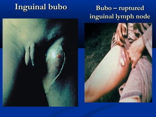 Inguinal buboInguinal bubo Bubo – rupturedBubo – ruptured
inguinal lymph nodeinguinal lymph node
 