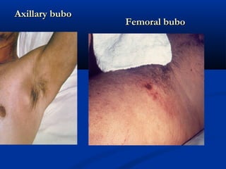 Axillary buboAxillary bubo
Femoral buboFemoral bubo
 