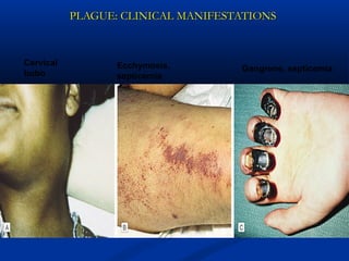 PLAGUE: CLINICAL MANIFESTATIONSPLAGUE: CLINICAL MANIFESTATIONS
Cervical
bubo
Ecchymosis,
septicemia
Gangrene, septicemia
 