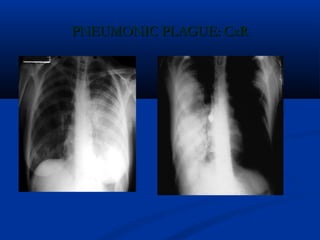 PNEUMONIC PLAGUE: CxRPNEUMONIC PLAGUE: CxR
 