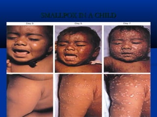 SMALLPOX IN A CHILDSMALLPOX IN A CHILD
 