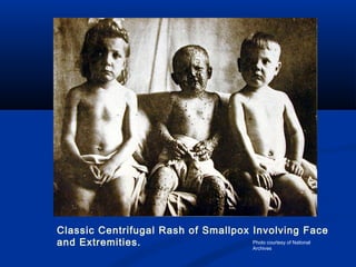 Classic Centrifugal Rash of Smallpox Involving Face
and Extremities. Photo courtesy of National
Archives
 