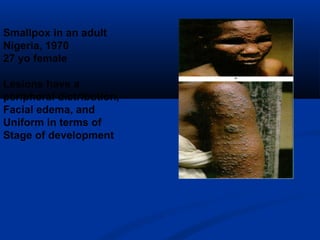 Smallpox in an adult
Nigeria, 1970
27 yo female
Lesions have a
peripheral distribution,
Facial edema, and
Uniform in terms of
Stage of development
 