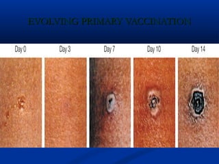 EVOLVING PRIMARY VACCINATIONEVOLVING PRIMARY VACCINATION
 