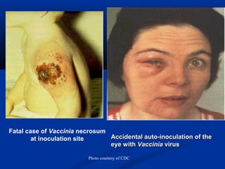 Photo courtesy of CDC
Fatal case of Vaccinia necrosum
at inoculation site Accidental auto-inoculation of theAccidental auto-inoculation of the
eye witheye with VacciniaVaccinia virusvirus
 