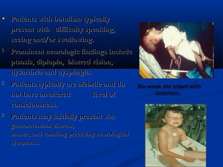 • Patients with botulism typicallyPatients with botulism typically
present with difficulty speaking,present with difficulty speaking,
seeing and/or swallowing.seeing and/or swallowing.
 Prominent neurologic findings includeProminent neurologic findings include
ptsosis, diplopia, blurred vision,ptsosis, diplopia, blurred vision,
dysarthria and dysphagia.dysarthria and dysphagia.
 Patients typically are afebrile and doPatients typically are afebrile and do
not have an altered level ofnot have an altered level of
consciousness.consciousness.
 Patients may initially presentPatients may initially present withwith
gastrointestinal distress,gastrointestinal distress,
nausea, and vomiting preceding neurologicalnausea, and vomiting preceding neurological
symptoms.symptoms.
Six-week old infant with
botulism.
 