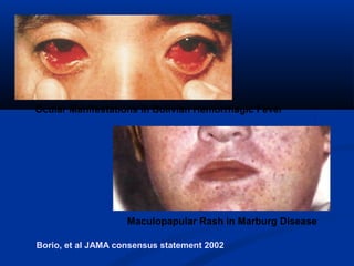 Borio, et al JAMA consensus statement 2002
Maculopapular Rash in Marburg Disease
Ocular Manifestations in Bolivian Hemorrhagic Fever
 