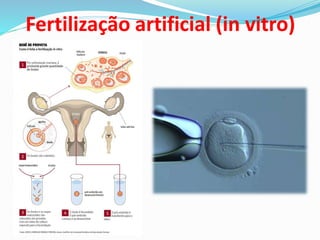 Fertilização artificial (in vitro)
 