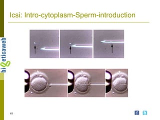 Icsi: Intro-cytoplasm-Sperm-introduction 