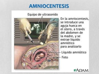 AMNIOCENTESIS
 