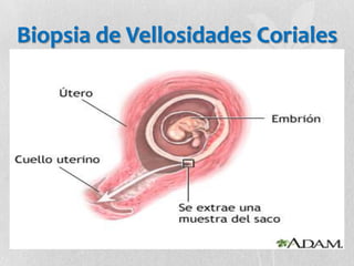 Biopsia de Vellosidades Coriales
 