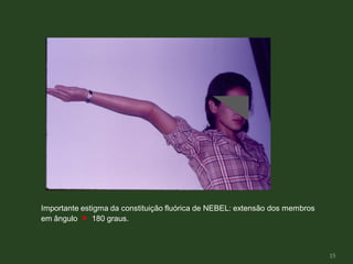 Importante estigma da constituição fluórica de NEBEL: extensão dos membros
em ângulo > 180 graus.
15
 