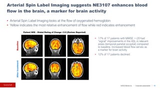 ©2023 BioVie Inc. I Corporate presentation
Arterial Spin Label Imaging suggests NE3107 enhances blood
flow in the brain, a marker for brain activity
14
Baseline
After
treatment
• Arterial Spin Label Imaging looks at the flow of oxygenated hemoglobin
• Yellow indicates the most relative enhancement of flow while red indicates enhancement
Patient N08 – Global Rating of Change +3.5 (Partner Reported)
• 17% of 17 patients with MMSE >=20 had
“signal” improvements in the ASL in relevant
areas (temporal parietal occipital) compared
to baseline. Increased blood flow serves as
a marker for brain activity
• 12% of 17 patients declined
 